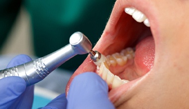 dentist polishing teeth