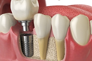 Diagram highlighting components of a dental implant in Medina.