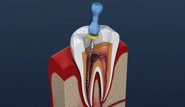 A diagram of root canal therapy.