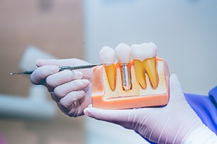 Dentist holding model of an integrated dental implant in Medina.
