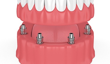 Digital model of an implant-retained denture.