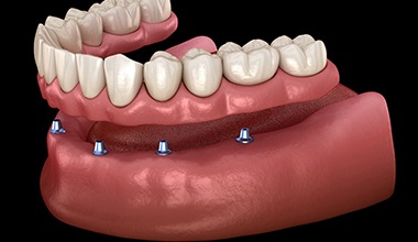 Image of an implant-supported denture.
