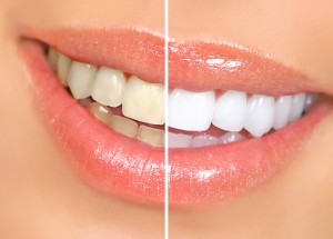 Mouth and teeth before and after whitening