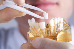 dental implants structure